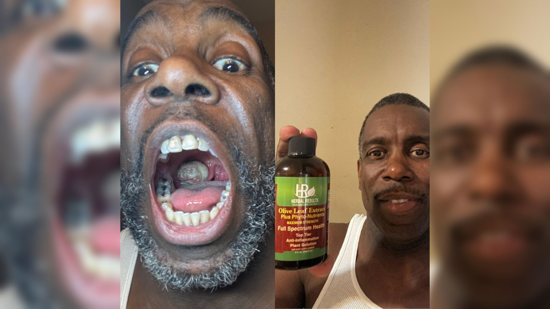 Throat Cancer Reversed with Surgery and Herbal Results Protocol