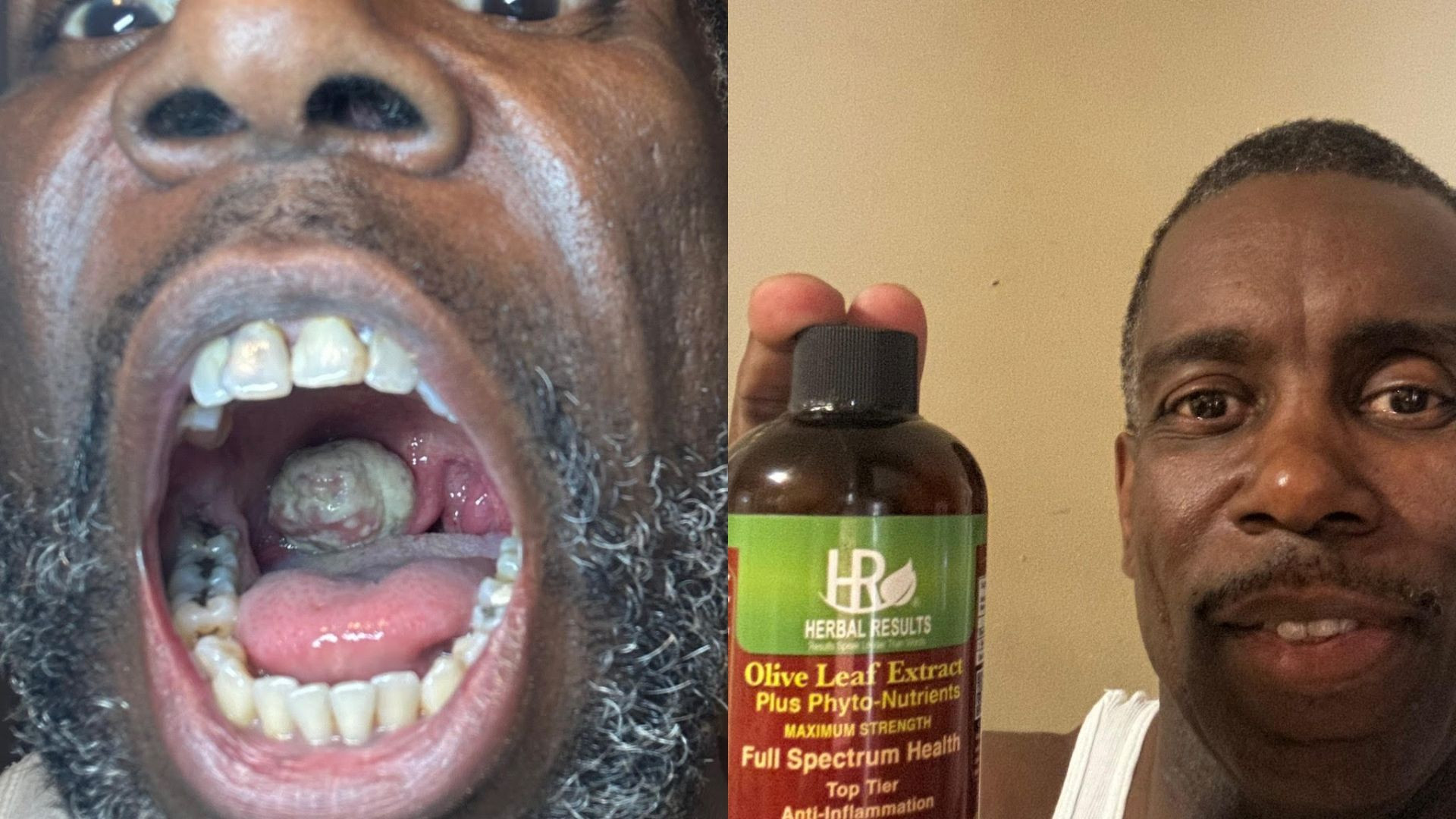Throat Cancer Reversed with Surgery and Herbal Results Protocol
